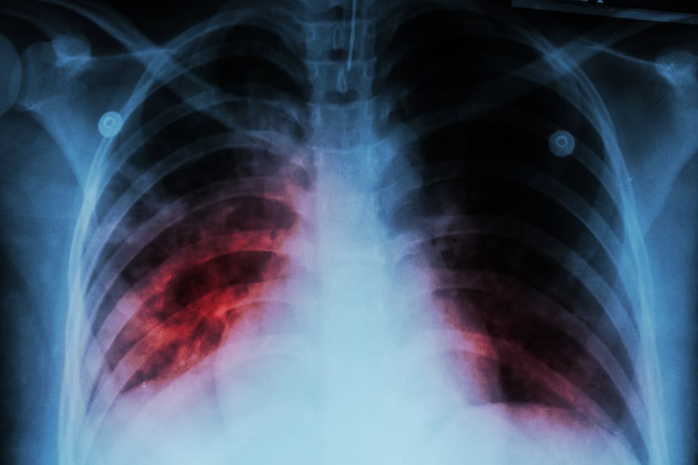Focolaio di Tubercolosi ad Alcamo: quattro casi accertati, situazione sotto controllo