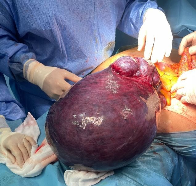 Marsala, asportato un fibroma uterino di 16 chili: intervento di particolare complessità
