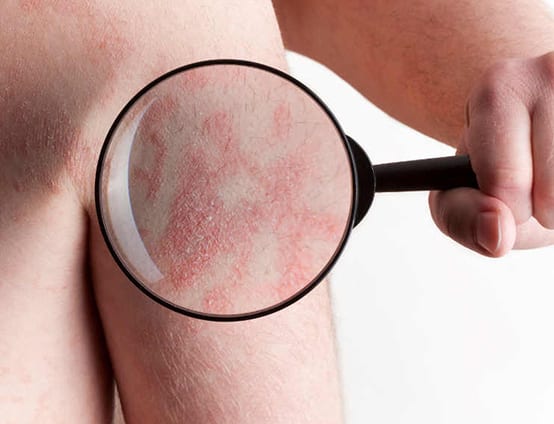 Trapani, “Psoriasi: informarsi è curarsi”: sabato consulti dermatologici gratuiti