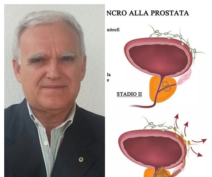 Prostata, test innovativo a Trapani e Marsala. Prima ASP siciliana a farlo