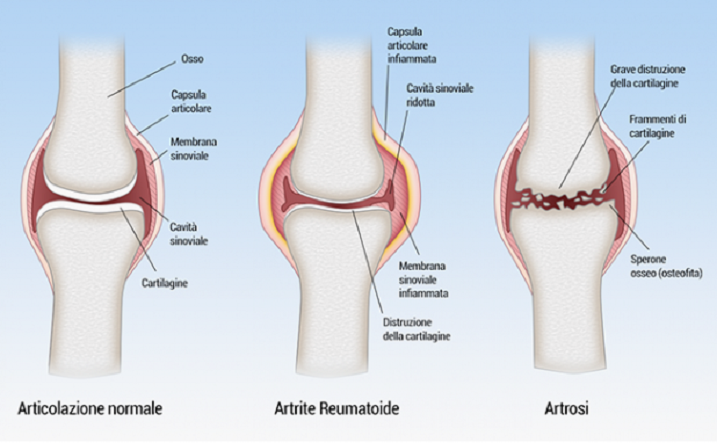 Osteoartrosi, confronto ad Alcamo fra specialisti e medici di famiglia